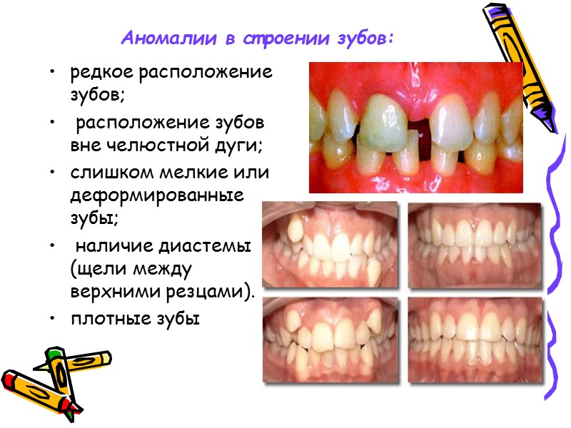 Аномалии в строении зубов: редкое расположение зубов;  расположение зубов вне челюстной дуги; слишком